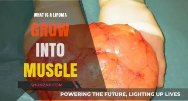 Understanding Lipomas: Can These Fatty Tumors Grow into Muscle Tissue?