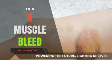 Understanding Muscle Bleeds: Causes and Treatment