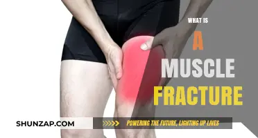 Understanding Muscle Fractures: What You Need to Know