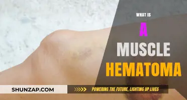 Muscle Hematoma: Understanding the Cause and Treatment