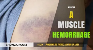 Understanding Muscle Hemorrhage: Causes and Treatment