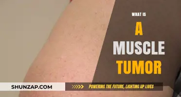 Understanding Muscle Tumors: What You Need to Know