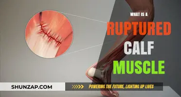 Understanding Ruptured Calf Muscles: Causes, Symptoms, and Recovery