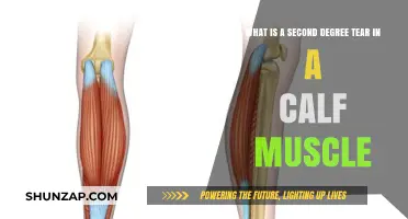 Understanding Second Degree Calf Muscle Tears: Causes, Symptoms, and Recovery