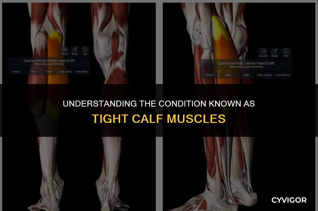 what is a tight calf muscle called