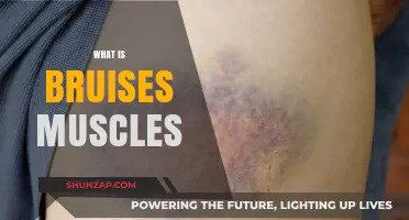 Understanding Bruised Muscles: Causes and Treatment