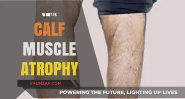 Understanding Calf Muscle Atrophy: Causes, Symptoms, and Treatment Options