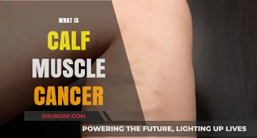 Understanding Calf Muscle Cancer: Symptoms, Diagnosis, and Treatment Options