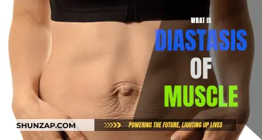 Understanding Diastasis Recti: Muscle Separation and Its Implications