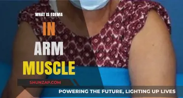 Understanding Edema: Causes and Effects in Arm Muscles Explained