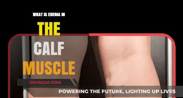 Understanding Calf Muscle Edema: Causes, Symptoms, and Effective Treatments