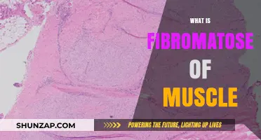 Muscle Fibromatoses: Understanding the Mystery
