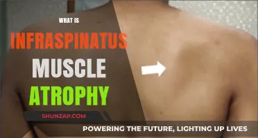Infraspinatus Muscle Atrophy: Understanding Shoulder Blade Muscle Wasting