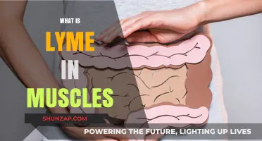 Lyme Disease: Muscle Pain and Treatment