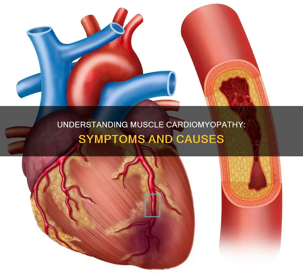 what is muscle cardiomyopathy