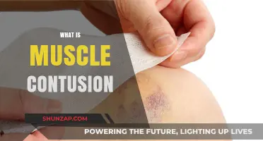 Muscle Contusion: Understanding Bruises and Their Treatment