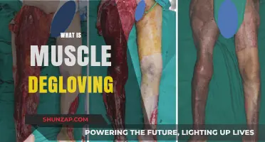 Understanding Muscle Degloving: A Rare and Severe Injury