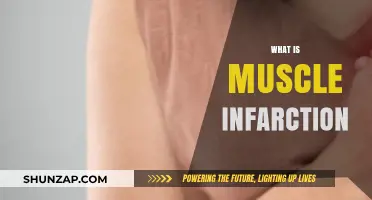 Muscle Infarction: Understanding the Condition