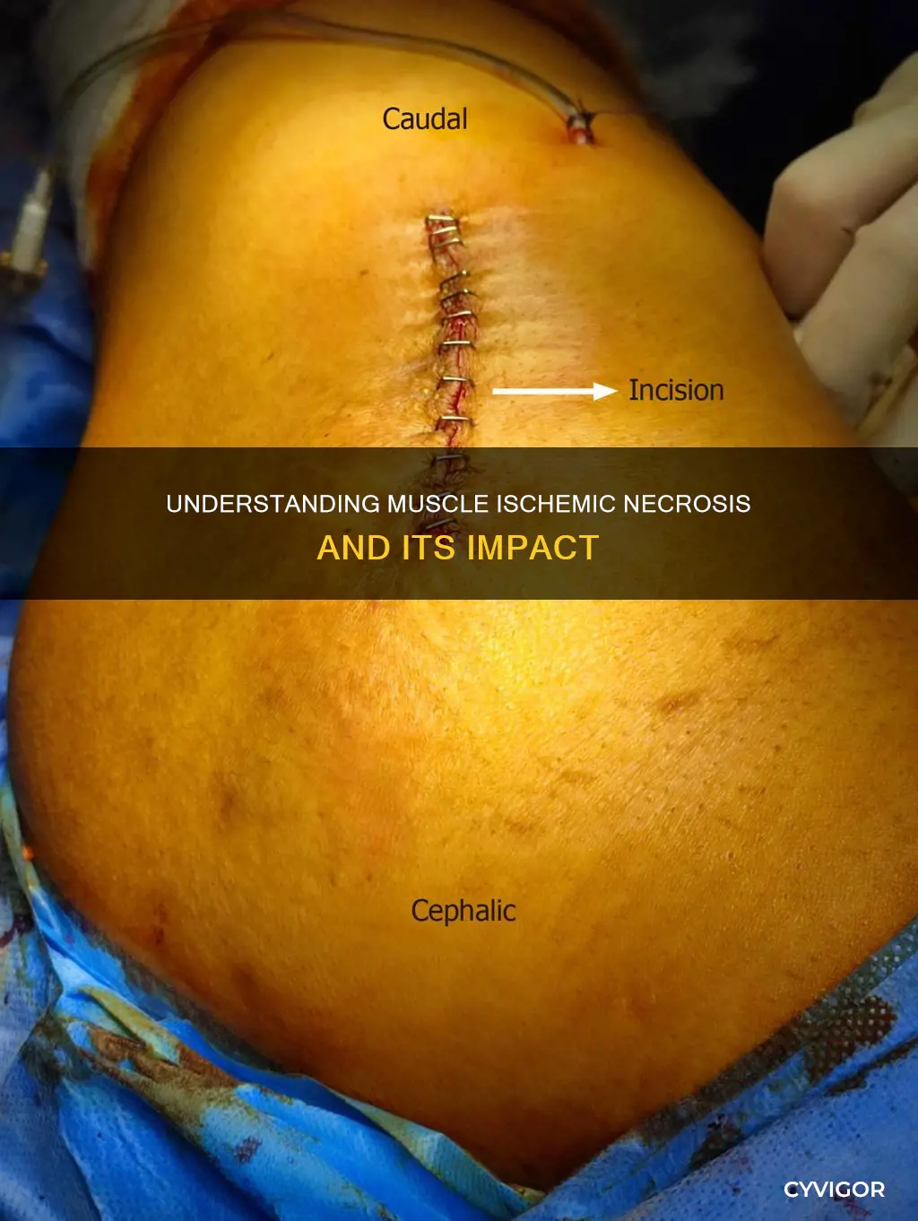 what is muscle ischemic necrosis
