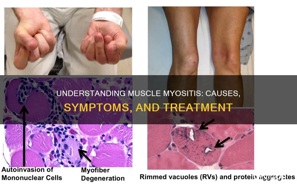 what is muscle myositis