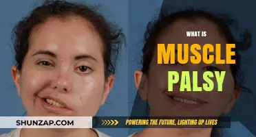 Understanding Muscle Palsy: Causes and Treatment