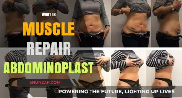 Muscle Repair Abdominoplasty: Transforming Your Core