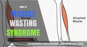 Understanding Muscle Wasting Syndrome: Causes and Treatments
