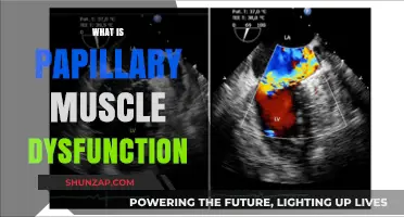 Papillary Muscle Dysfunction: Understanding Heart Function Impairment