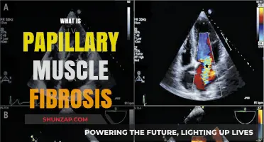 Papillary Muscle Fibrosis: Causes, Symptoms, and Treatment