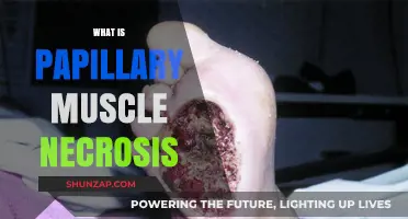 Papillary Muscle Necrosis: Understanding the Heart's Muscle Death