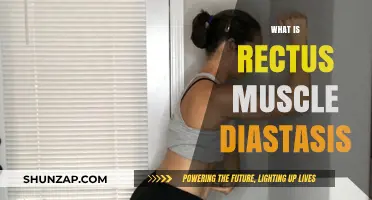 Understanding Rectus Muscle Diastasis: Causes and Treatment