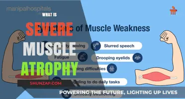 Muscle Atrophy: Understanding Severe Cases