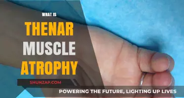 Understanding Thenar Muscle Atrophy: Causes and Implications