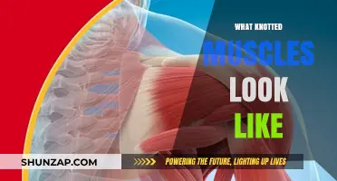 Understanding Knotted Muscles: Signs and Symptoms