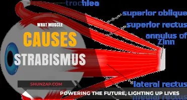 Understanding Strabismus: The Role of Extraocular Muscles in Eye Misalignment