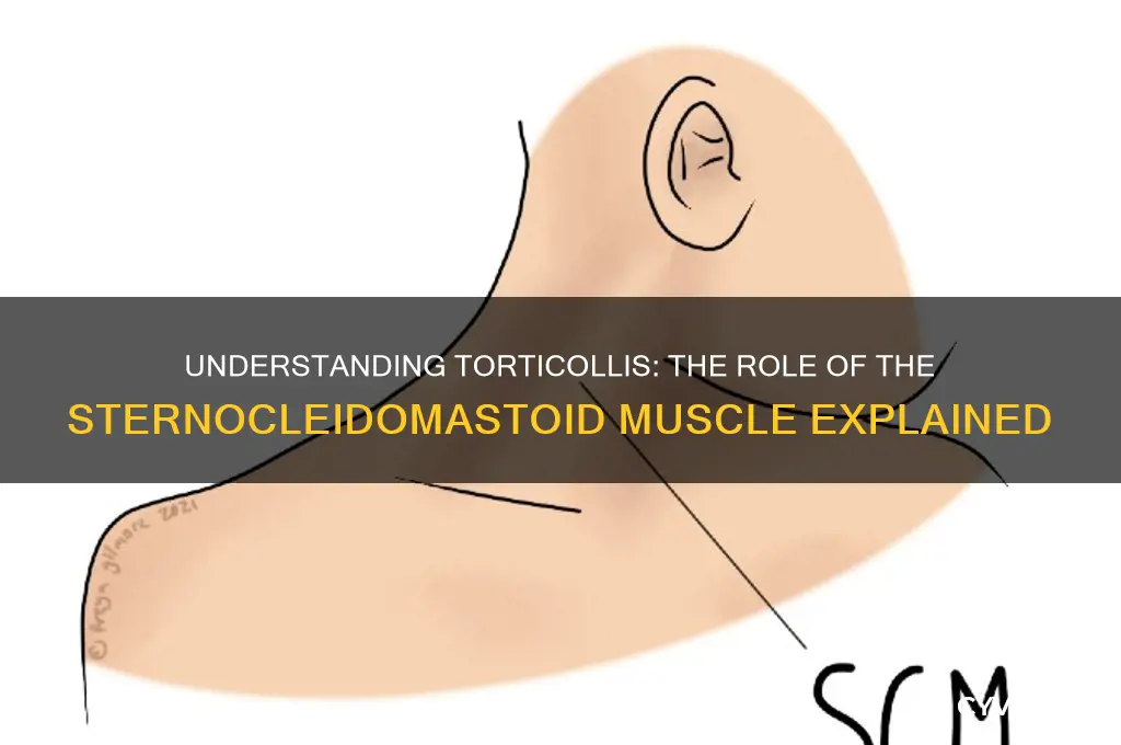 what muscle causes torticollis