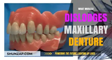 Muscles That Move: Maxillary Denture Dislodgement