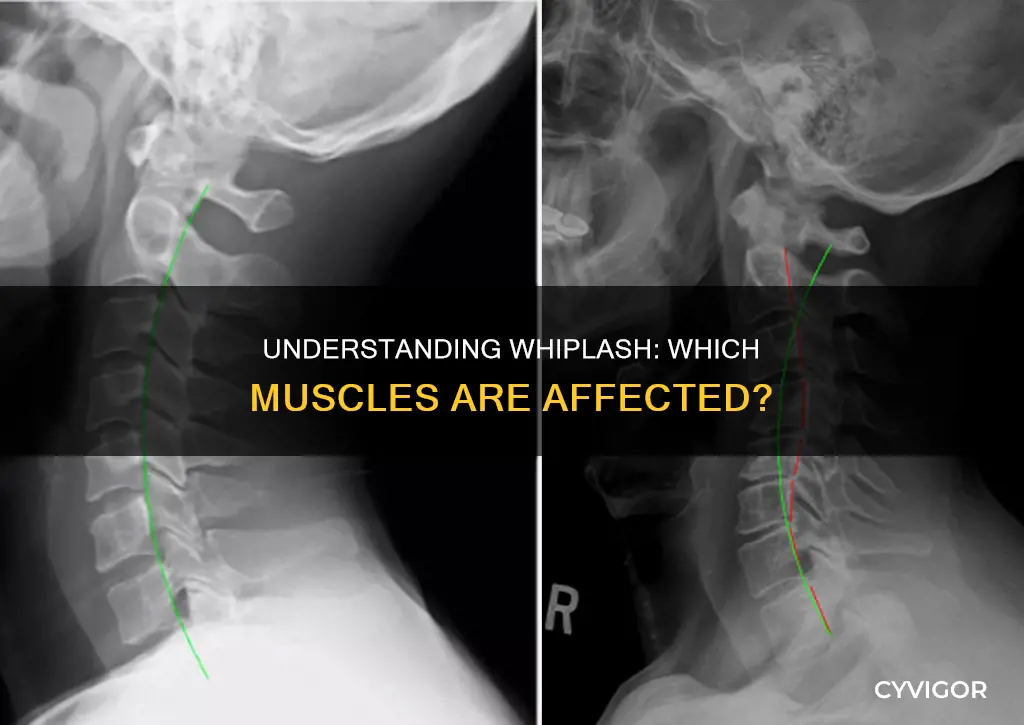 what muscle injured whiplash