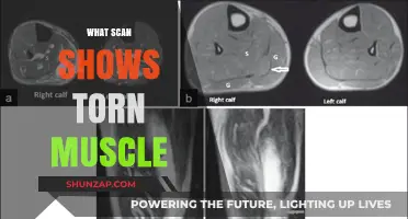 MRI Scans: The Ultimate Tool for Torn Muscle Diagnosis