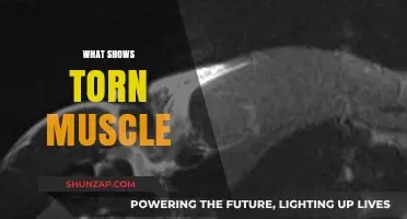 Visible Signs of a Torn Muscle
