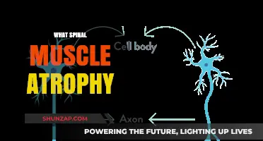 Understanding Spinal Muscular Atrophy: Causes and Symptoms