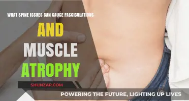 Spine Disorders Linked to Fasciculations and Muscle Atrophy Explained