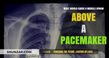 Pacemaker-Related Muscle Spasms: Causes and Concerns Explained
