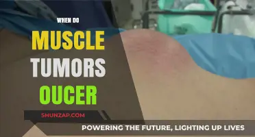 Muscle Tumors: When Do They Occur?