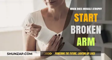 Muscle Atrophy After a Broken Arm: When Does It Begin?