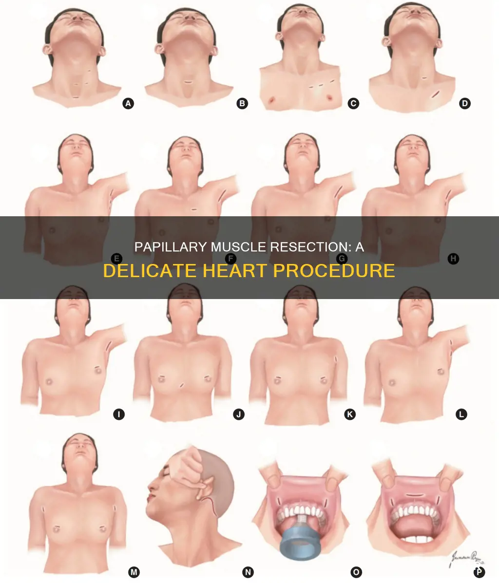 when excise papillary muscle