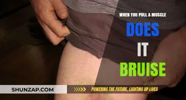 Does Pulling a Muscle Cause Bruising? Understanding Muscle Injuries