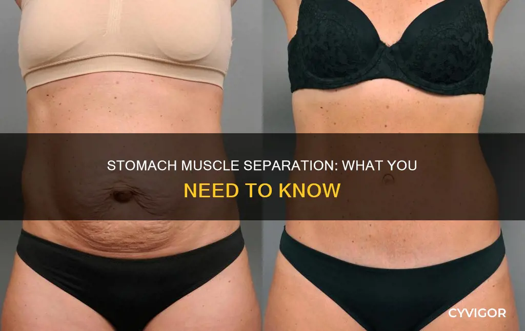 when your stomach muscles separate