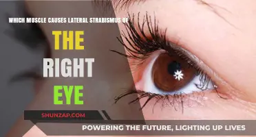 Lateral Strabismus in the Right Eye: The Role of the Lateral Rectus Muscle