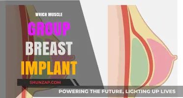 Breast Implants and Muscle Placement: Which Group is Best?